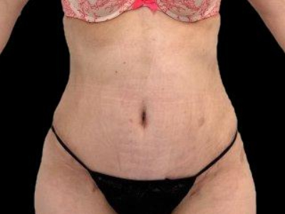 After — Tummy Tuck, Patient #60014