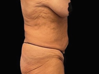 Before — Tummy Tuck, Patient #59594, view 2