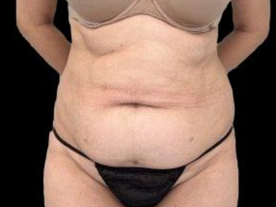 Before — Tummy Tuck, Patient #60014