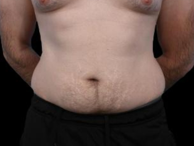 Before — Tummy Tuck, Patient #77187