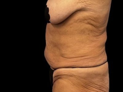 Before — Tummy Tuck, Patient #59594