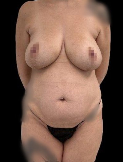 Before — Mommy Makeover, Patient #40102