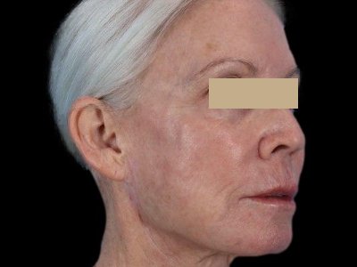 After — ReGen Dermacore, Patient #14648