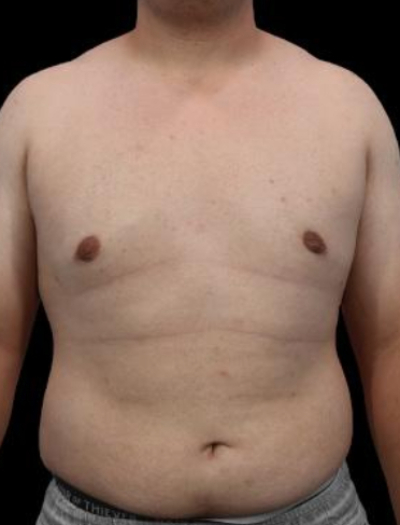 After — S.M.A.R.T. Core Contour, Patient #41431
