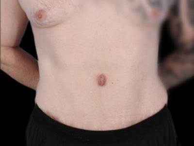 After — Tummy Tuck, Patient #94281