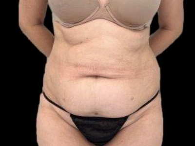Before — Tummy Tuck, Patient #53183