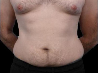 Before — Tummy Tuck, Patient #94281