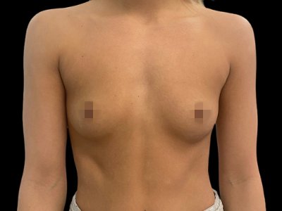 Before — Breast Augmentation, Patient #63047