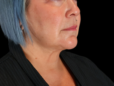 After — Chin Liposuction, Patient #71986