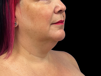 Before — Chin Liposuction, Patient #71986