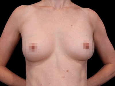 After — The True Shape Breast Augmentation, Patient #11631