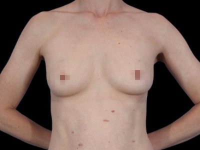 Before — The True Shape Breast Augmentation, Patient #11631
