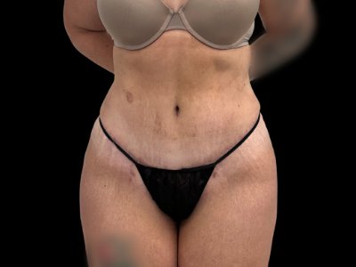 After — Tummy Tuck, Patient #38701