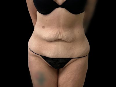 Before — Tummy Tuck, Patient #38701