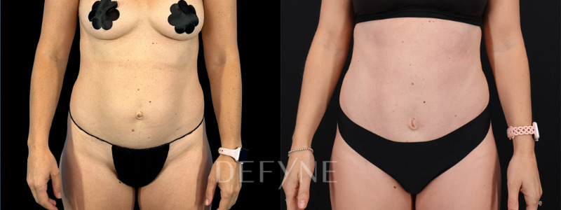 Patient #8557 Combined Image