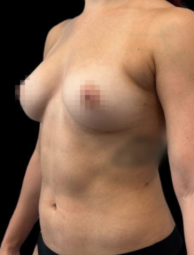 After — 360° Refyne, Patient #18395, view 2