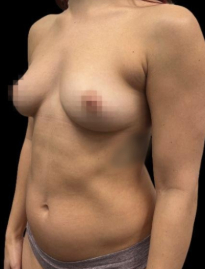 Before — 360° Refyne, Patient #18395, view 2