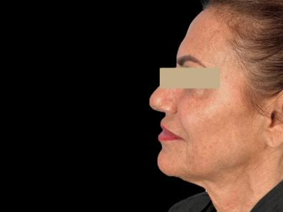 After — P.R.O. Facial Rejuvenation, Patient #33471