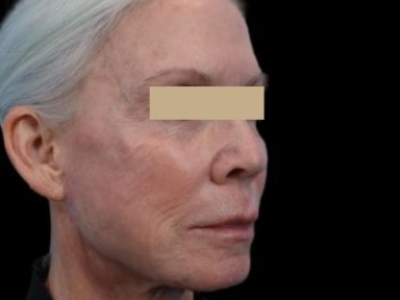 Before — ReGen Dermacore, Patient #14648