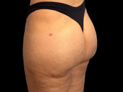 After — True Curve BBL, Patient #71796