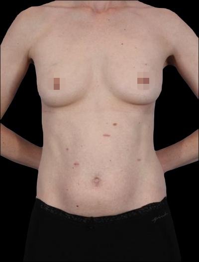 Before — 360° Refyne, Patient #82001