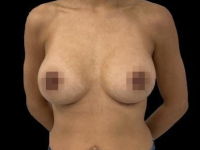 After — Breast Augmentation, Patient #104376