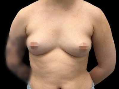 Before — Breast Augmentation, Patient #27276
