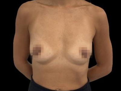 Before — Breast Augmentation, Patient #104376