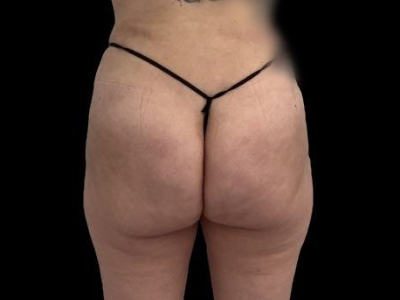 After — True Curve BBL, Patient #26436
