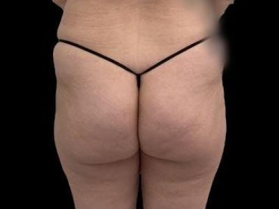 Before — True Curve BBL, Patient #26436